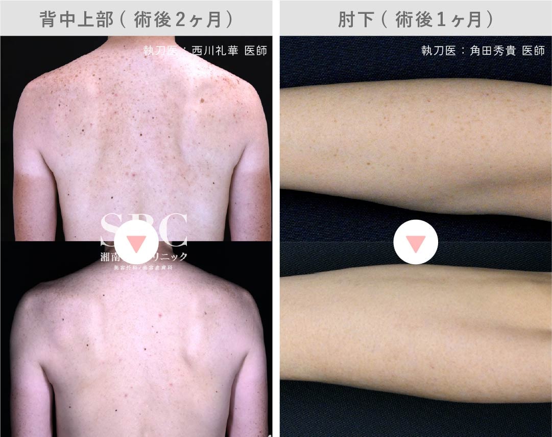 京都院のピコスポットシミ取り放題の症例写真2