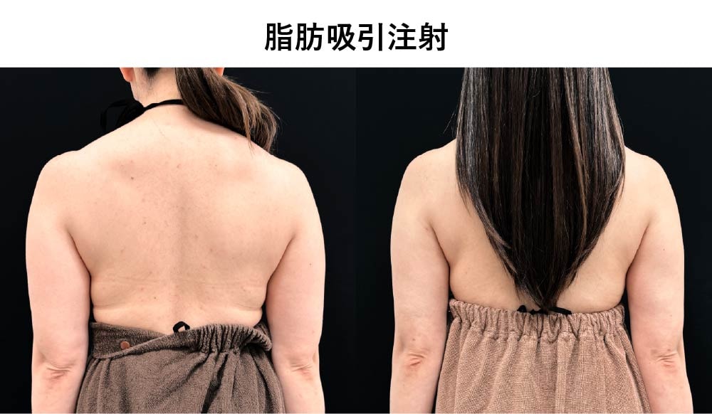 二の腕の症例写真