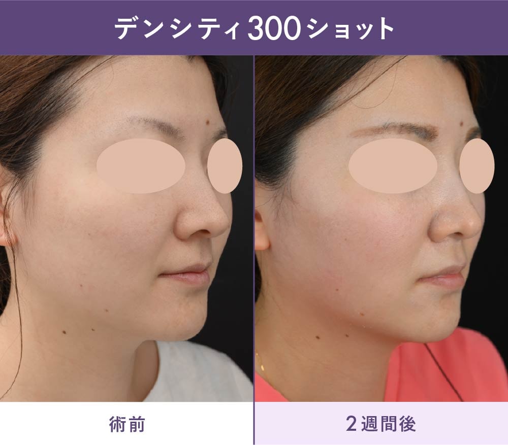 デンシティの症例写真