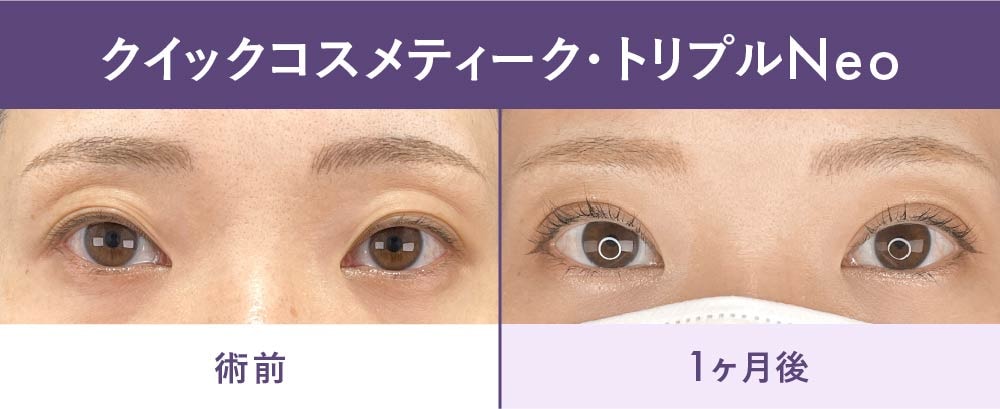 二重整形の症例写真