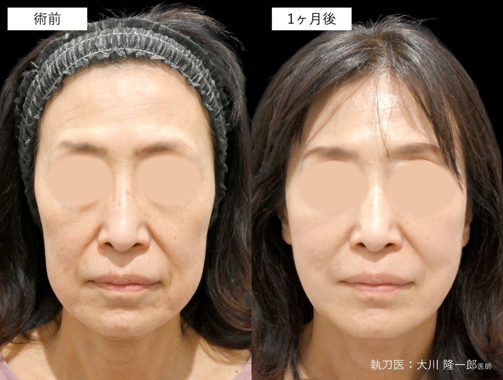 【50代女性】シークレット10本＋テスリフト4本