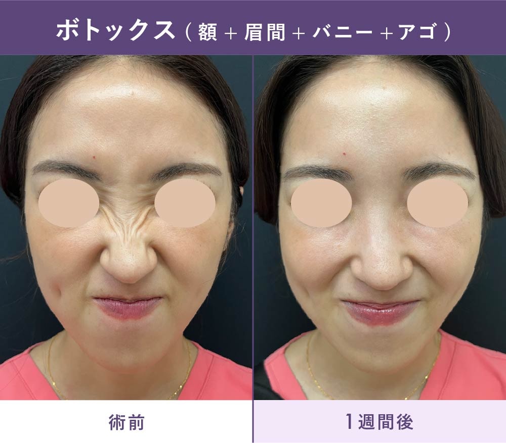 ボトックス治療の症例写真