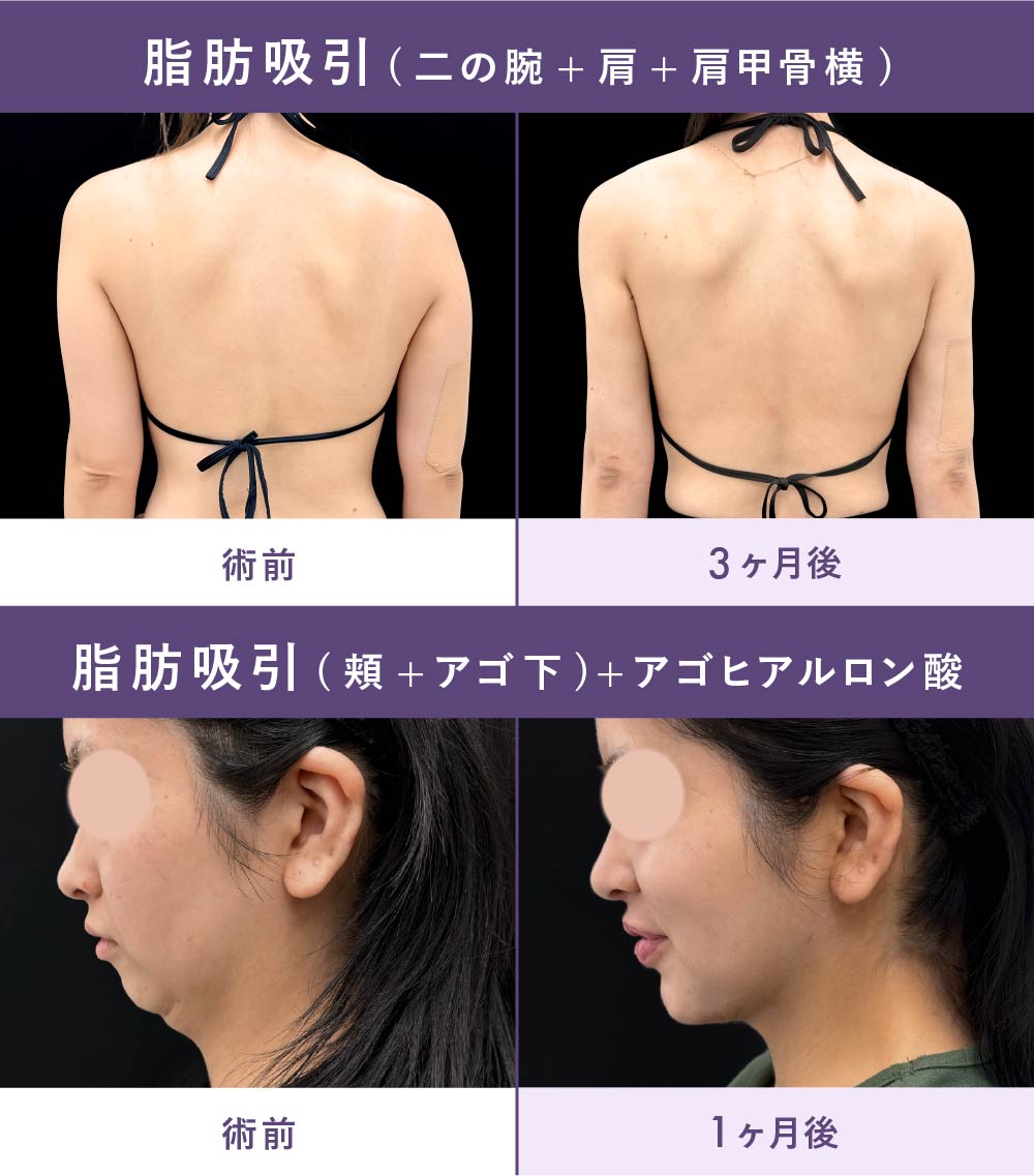 脂肪吸引の症例写真