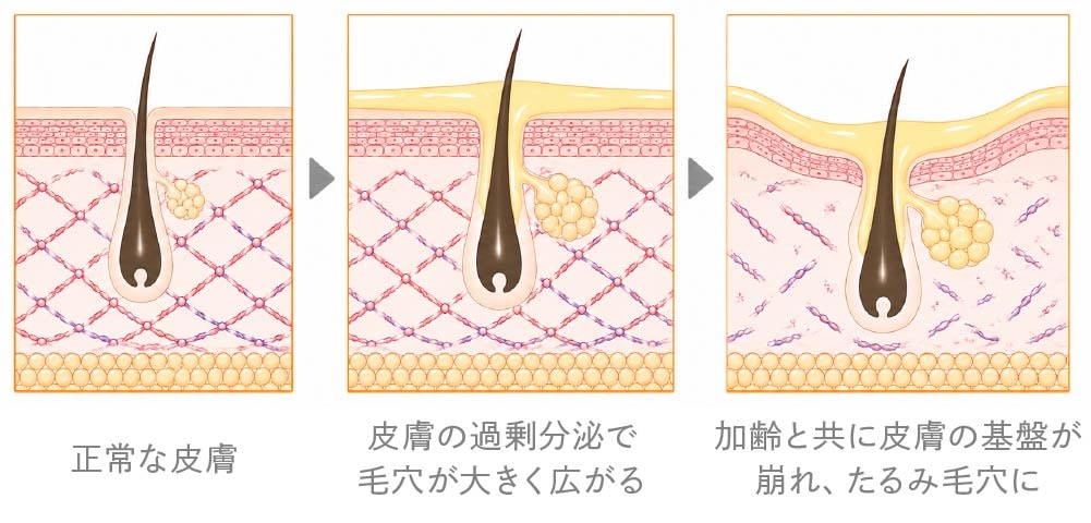 毛穴開きの医学的メカニズム図解