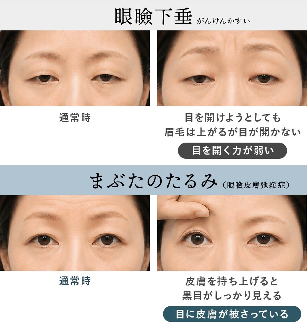 眼瞼下垂とまぶたのたるみの違いを図解で解説