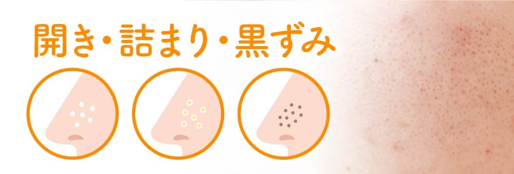 皮脂・詰まり・黒ずみ毛穴(いちご鼻)のイメージ