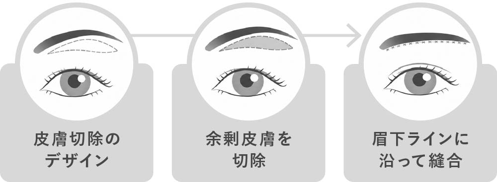 眉下リフト（眉下切開）の施術方法3STEP
