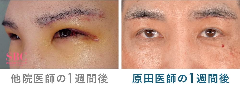 他院と湘南美容クリニック京都院 原田医師の眉下リフト術後1週間の傷跡比較