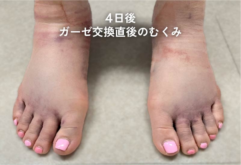 術後の足の強いむくみの様子