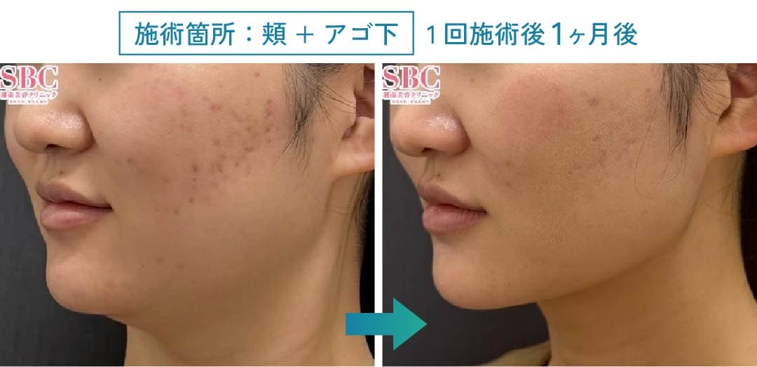 顔への効果症例1