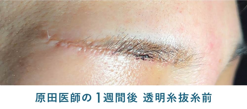眉下リフト抜糸前（透明糸）の綺麗な経過写真