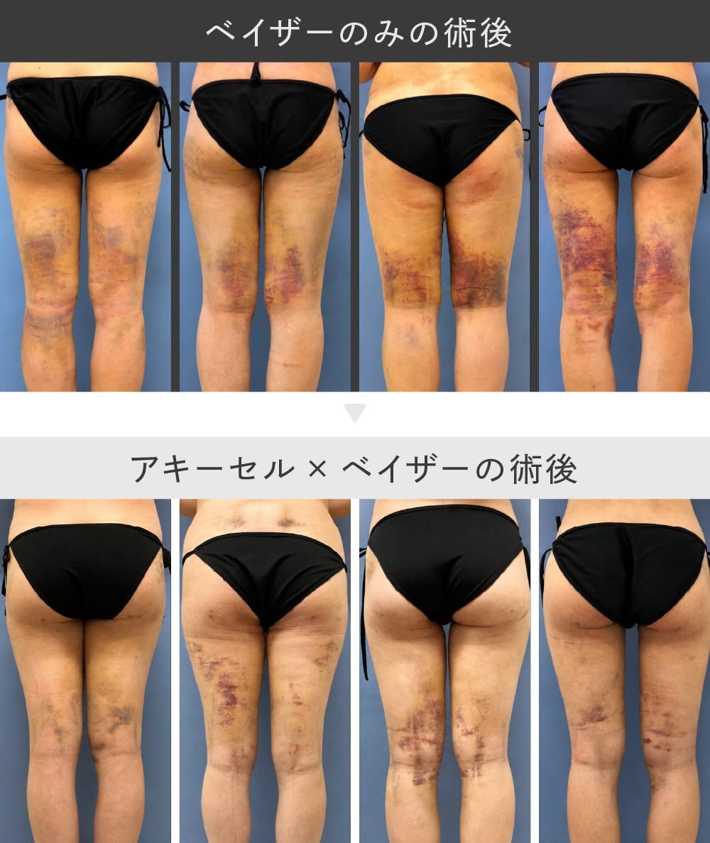 ベイザーとアキーセル併用による内出血や腫れの軽減比較