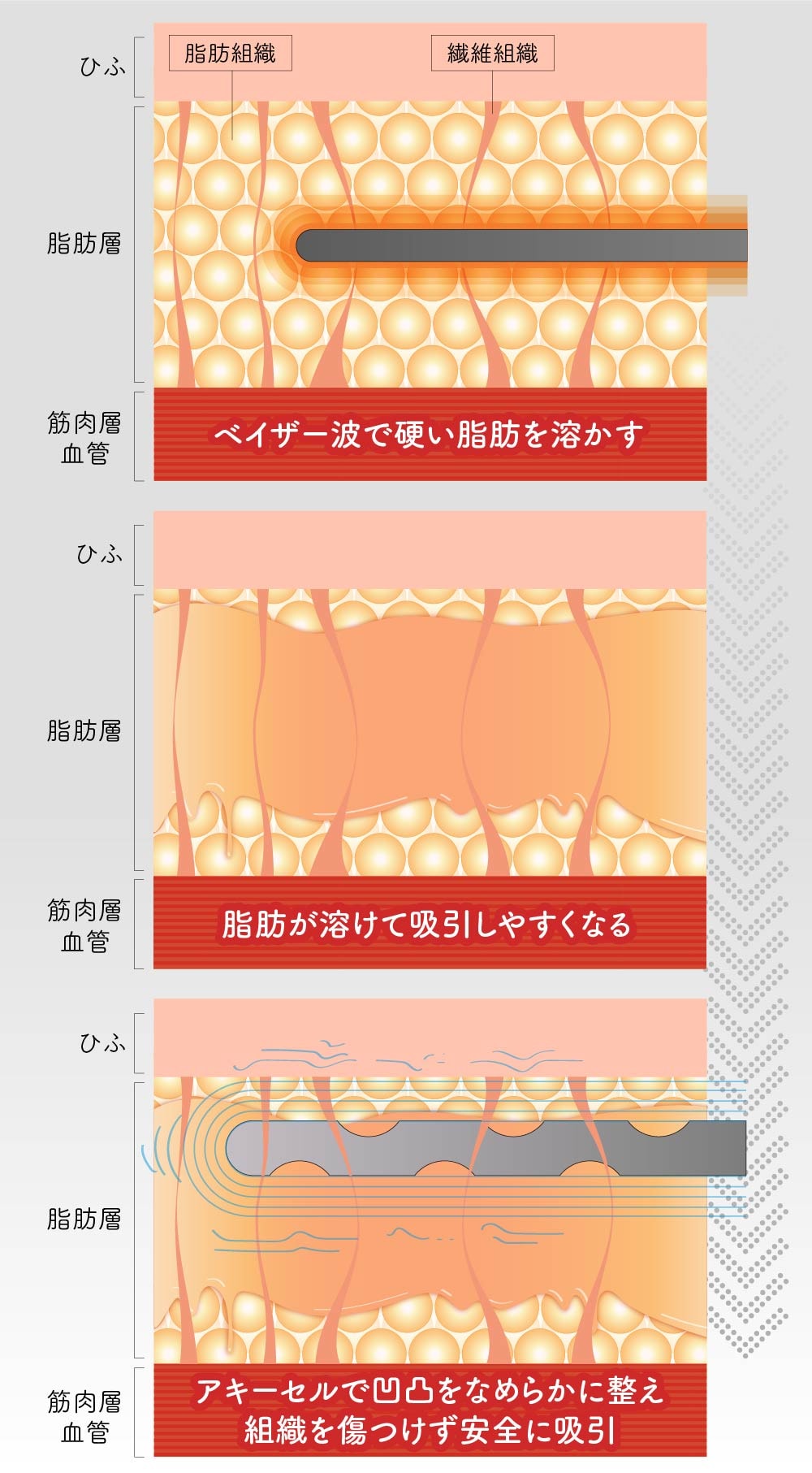 ベイザーとアキーセルのメカニズム図解