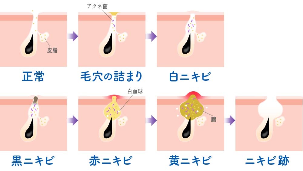 ニキビの進行メカニズム 白ニキビ 黒ニキビ 赤ニキビ Yellowニキビ