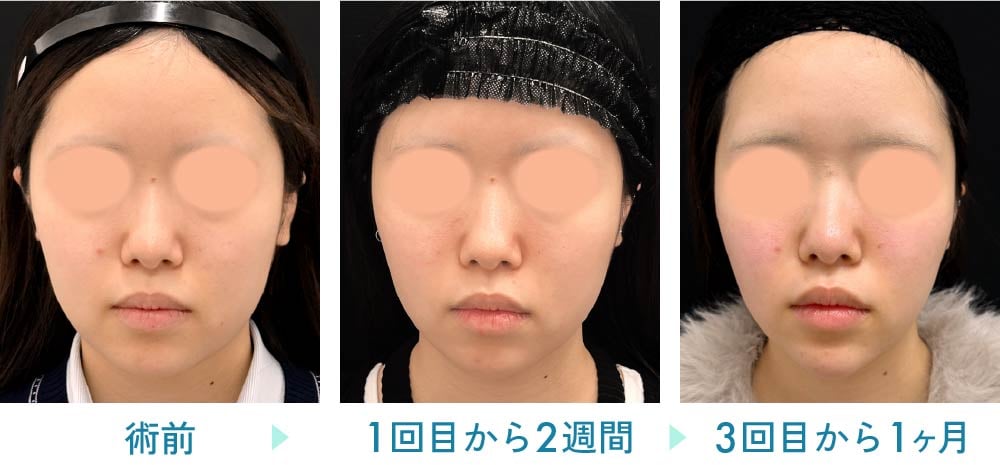 オンダリフト症例:10代女性 顔痩せ・Vライン形成
