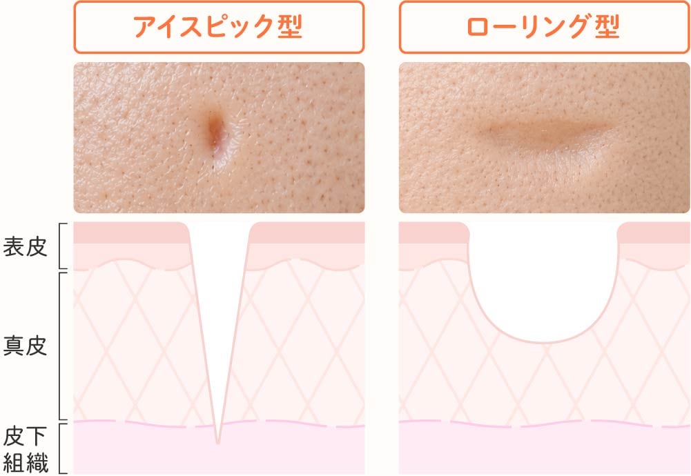 アイスピック型・ローリング型のクレーター毛穴の図解