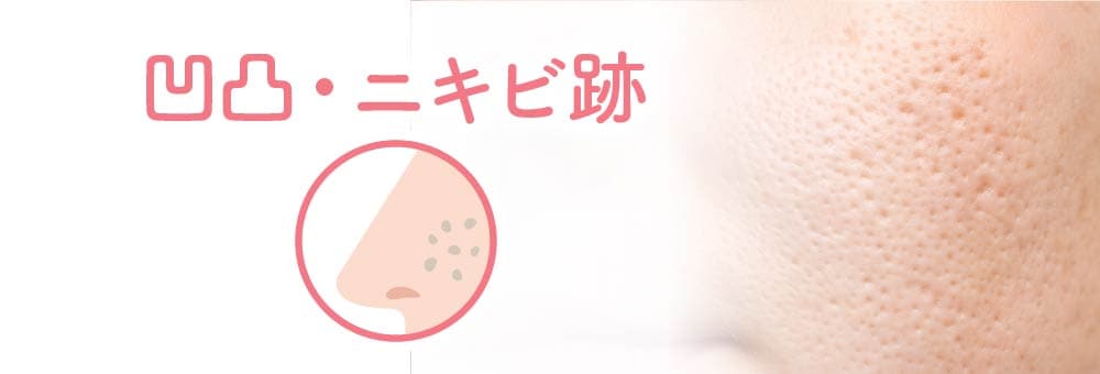 凹凸・ニキビ跡毛穴のイメージ