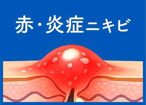 京都 ニキビでき始め 赤ニキビ 炎症ニキビ 治療