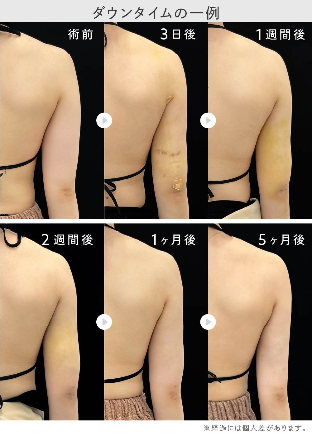 二の腕の脂肪吸引ダウンタイムの滑らかな仕上がり例