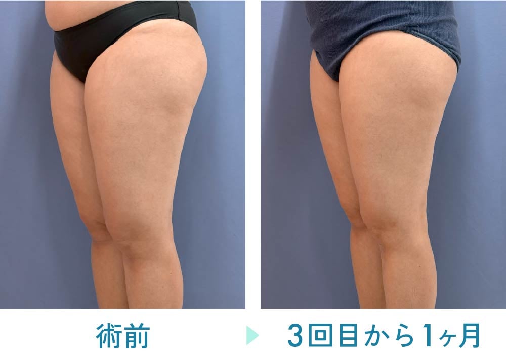 オンダリフト症例:30代女性 太もも前面の脚痩せ部分痩せ