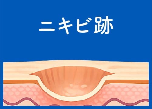 京都 ニキビ跡 クレーター 凹凸 治療
