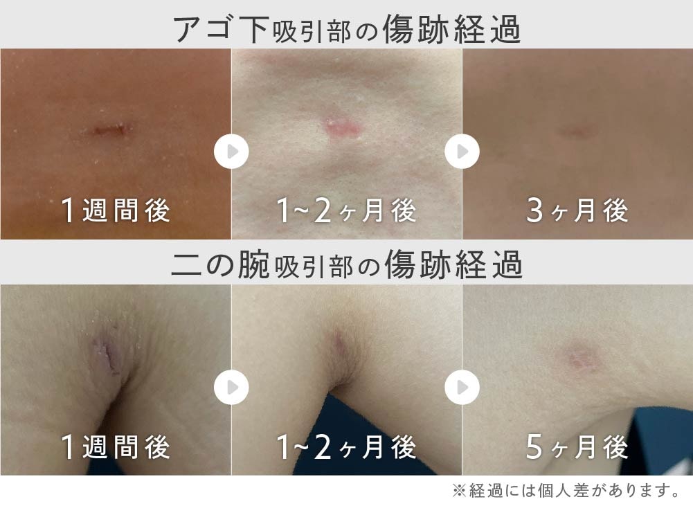 脂肪吸引の傷跡ダウンタイム経過