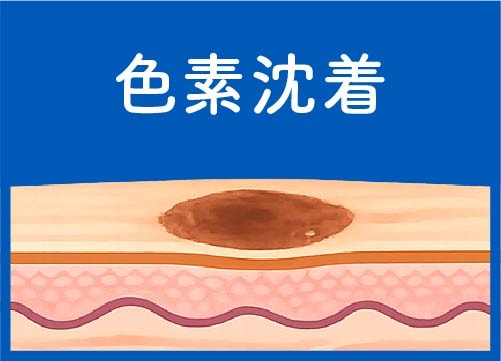 京都 白ニキビ 黒ニキビ 色素沈着 治療