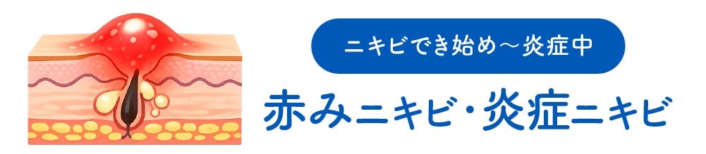 アクネライト 内服薬 エレクトロポレーション