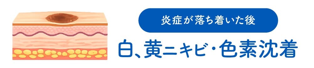ケミカルピーリング IPL光治療