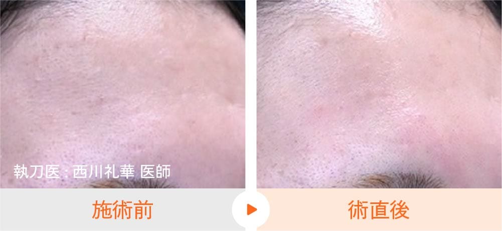 京都院でのヴェルベットスキンによる肌のハリツヤ改善の症例写真