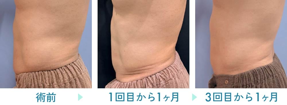 オンダリフト症例:50代男性 お腹周りのタイトニング部分痩せ