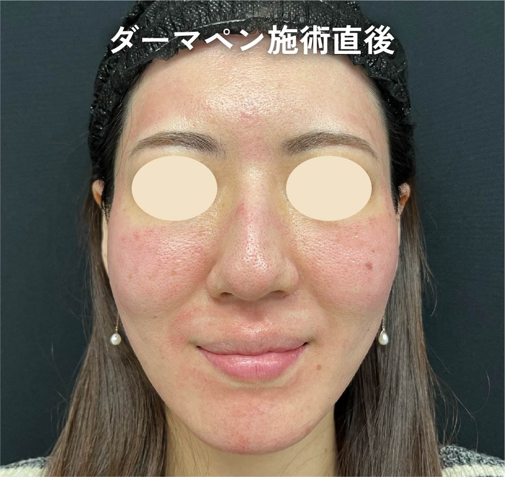 湘南美容クリニック京都院のダーマペン4施術直後の肌の赤みの様子