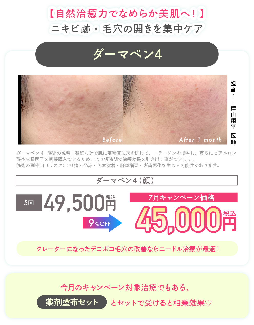 ダーマペン