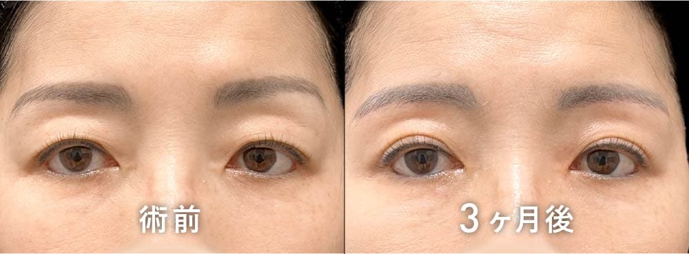 京都院 原田医師の眉下リフト(眉下切開) 40代症例写真：たるみによる眉の左右差改善