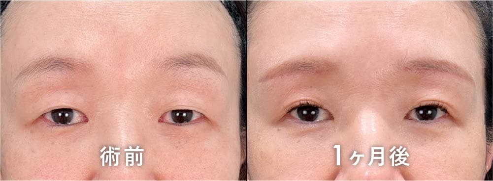 京都院 原田医師の眉下リフト(眉下切開) 40代症例写真：重いまぶたの改善とクマ取り併用