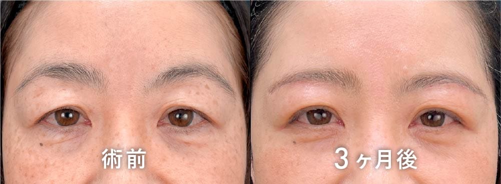 京都院 原田医師の眉下リフト(眉下切開) 50代症例写真：外側のたるみ改善と自然な仕上がり