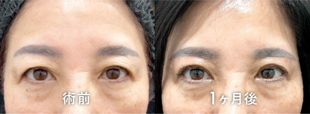 京都院 原田医師の眉下リフト(眉下切開) 60代以上の症例写真：たるみの左右差改善