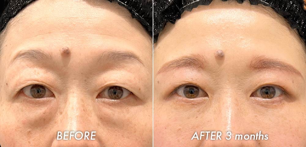 40代女性の若返り症例|眉下リフトと切開クマ取りによる目元のたるみ改善