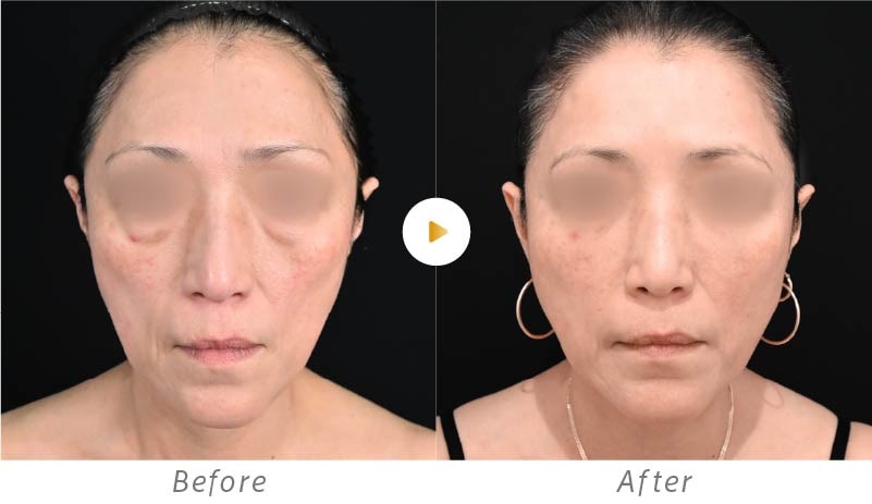 脂肪注入を用いたお顔の若返りの症例写真