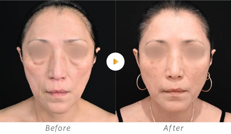 脂肪注入を用いたお顔の若返りの症例写真