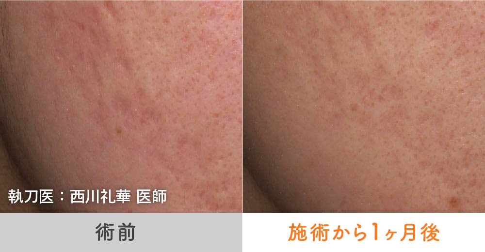 クレーター毛穴の症例写真