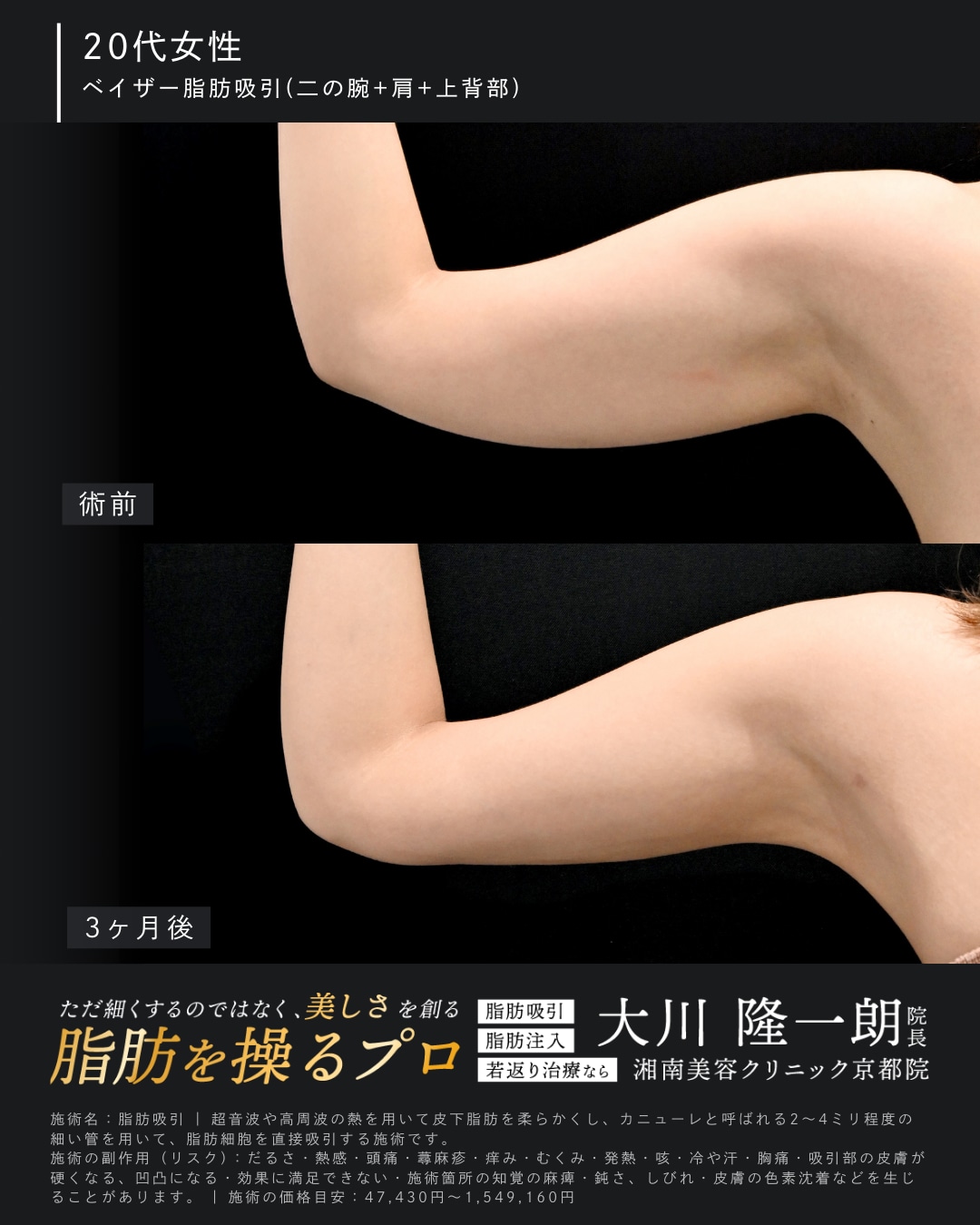 ベイザー脂肪吸引(二の腕＋肩＋上背部)の症例