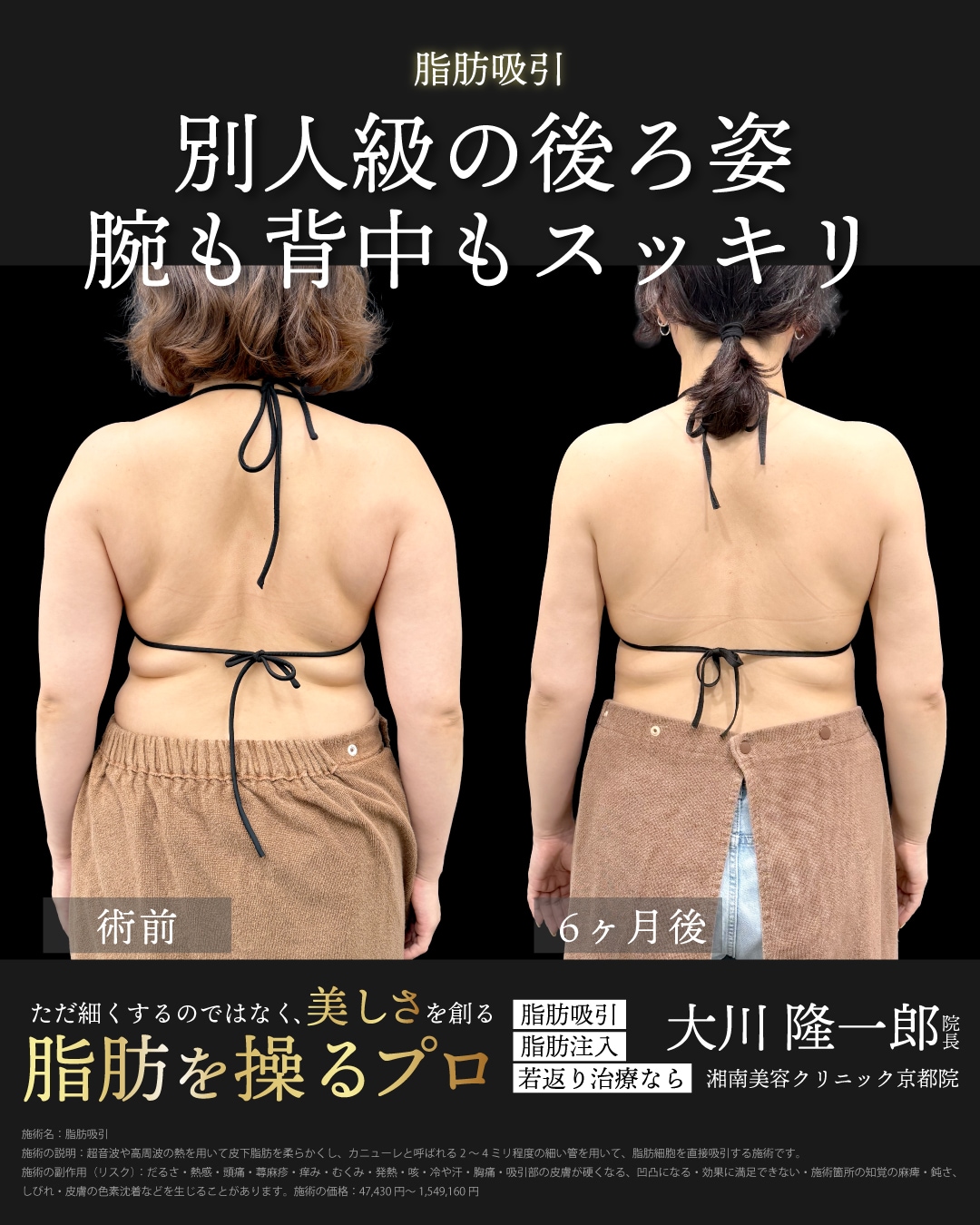 アキーセル脂肪吸引(二の腕＋肩＋肩甲骨横)＋ベイザー併用の症例