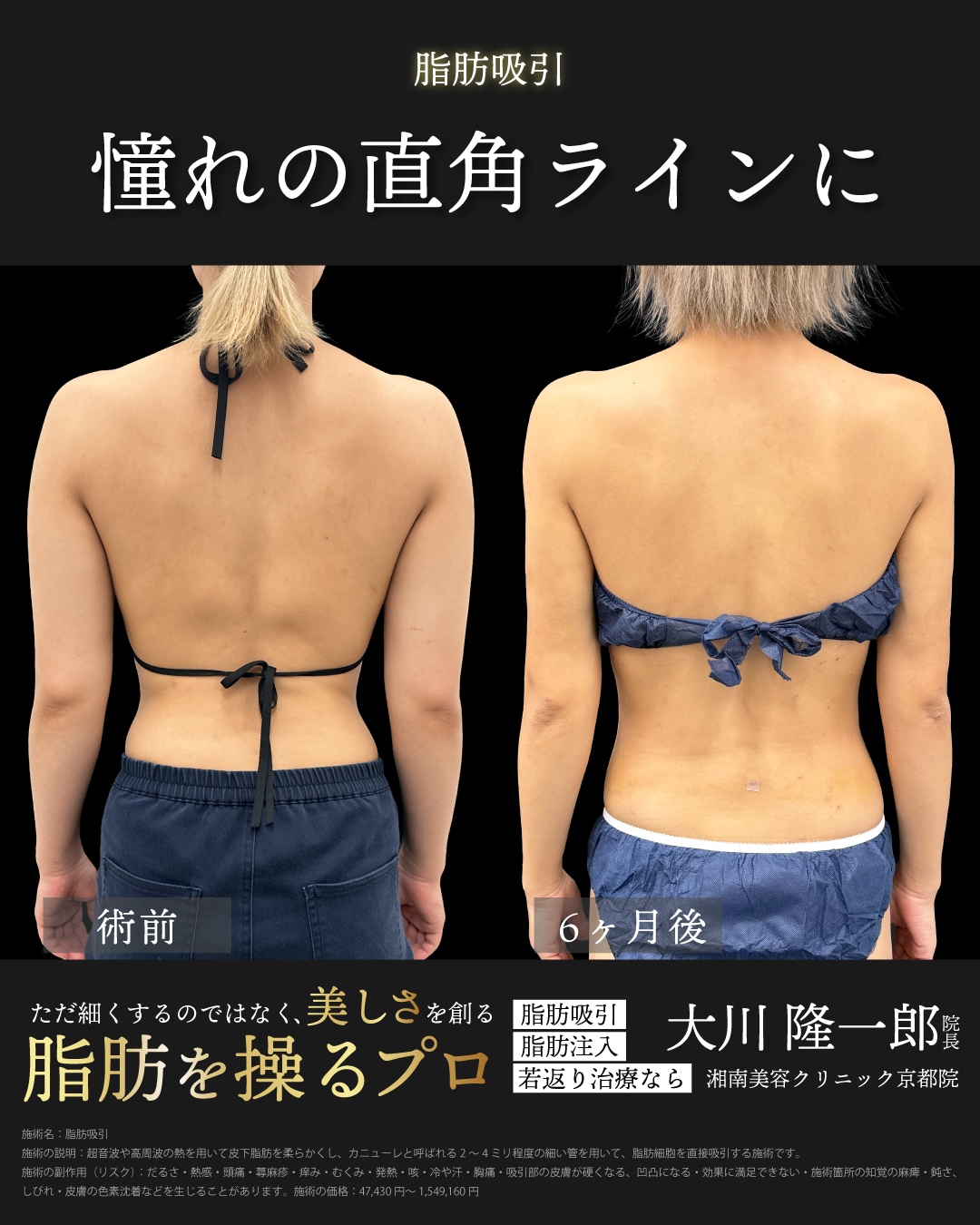 ベイザー脂肪吸引(二の腕＋肩＋肩甲骨横)の症例