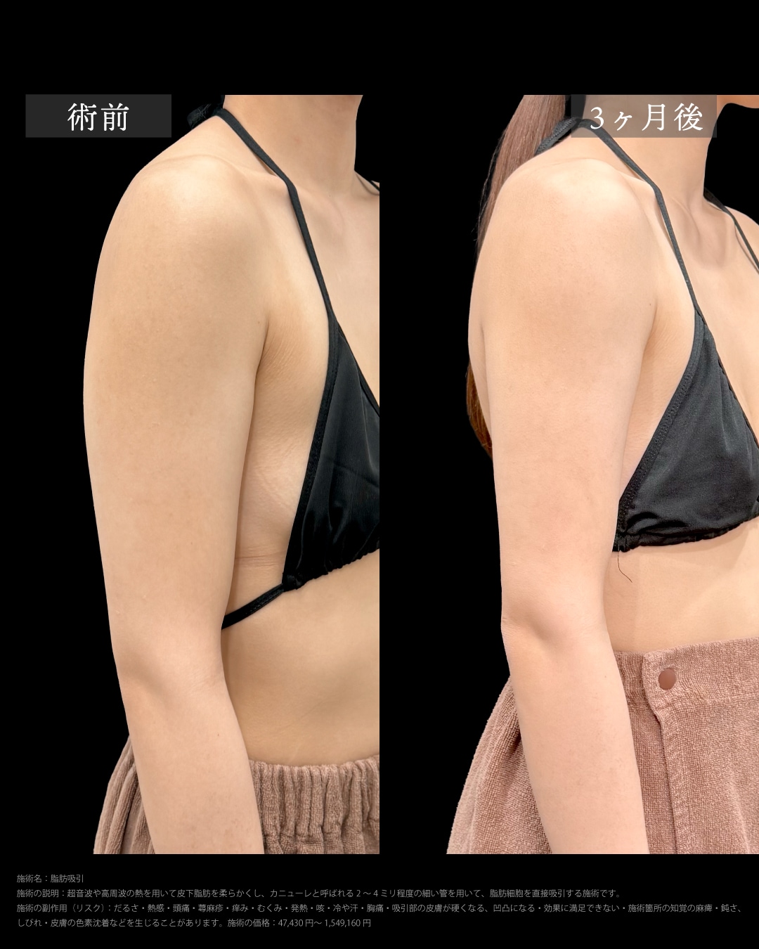 ベイザー脂肪吸引(二の腕＋肩)の症例