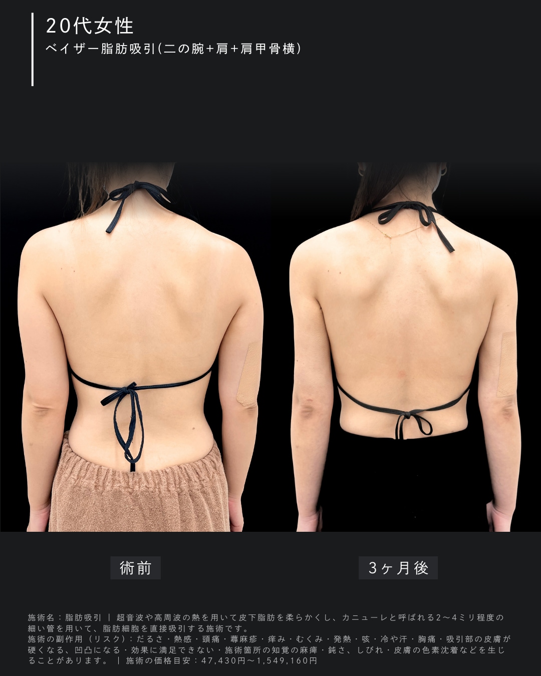 ベイザー脂肪吸引(二の腕＋肩＋肩甲骨横)の症例