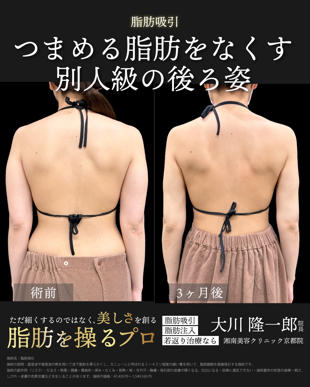 アキーセル脂肪吸引(二の腕全周＋肩＋肩甲骨横＋胸上部)＋ベイザー併用の症例
