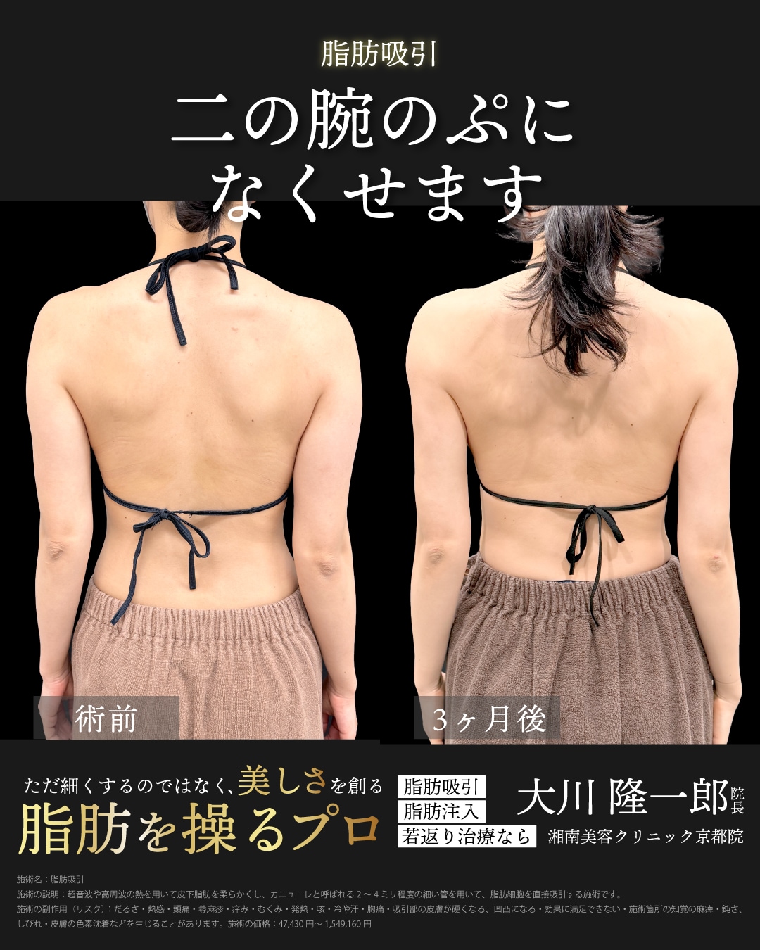ベイザー脂肪吸引(二の腕全周＋肩)の症例