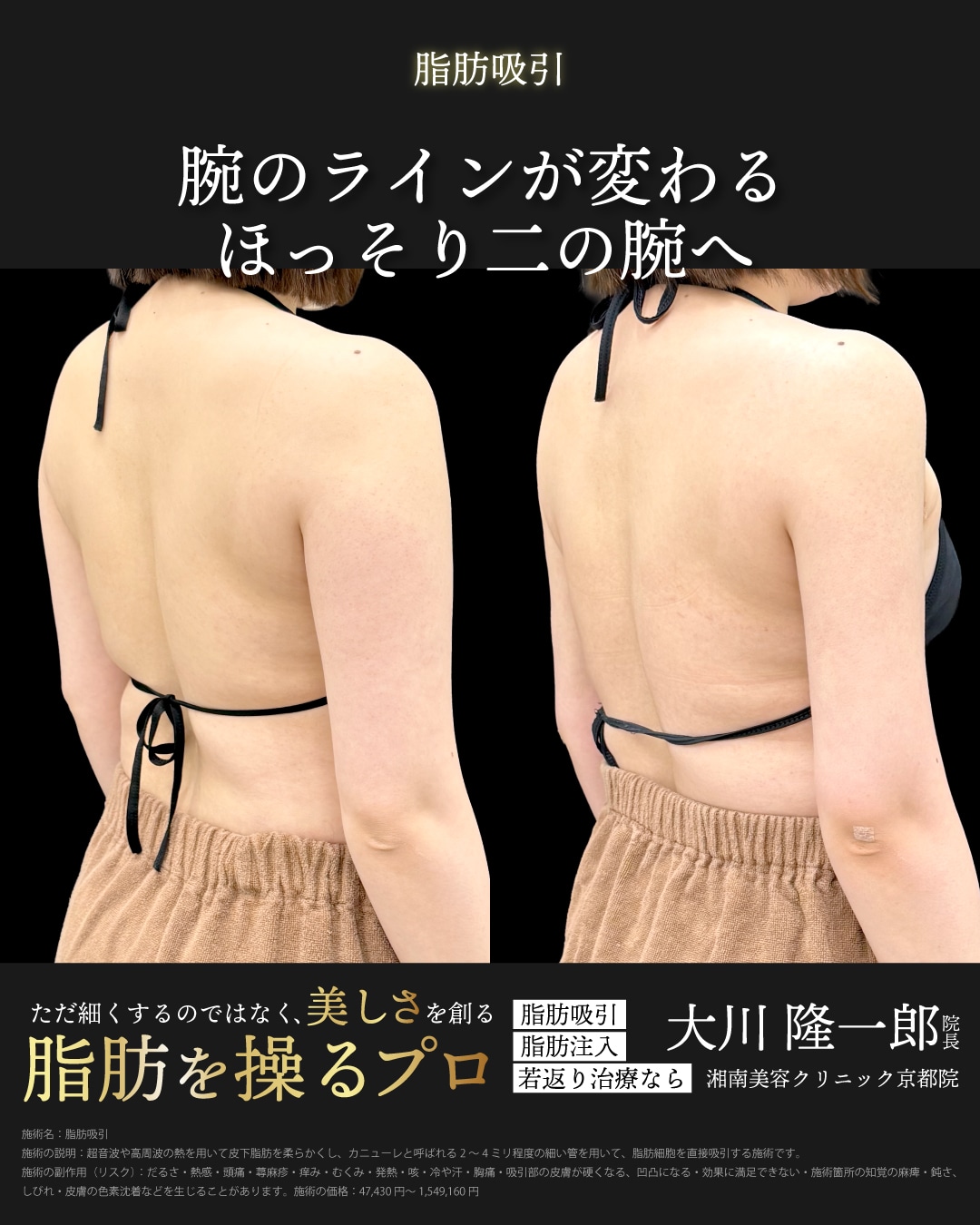 アキーセル脂肪吸引(二の腕全周＋肩)＋ベイザー併用の症例