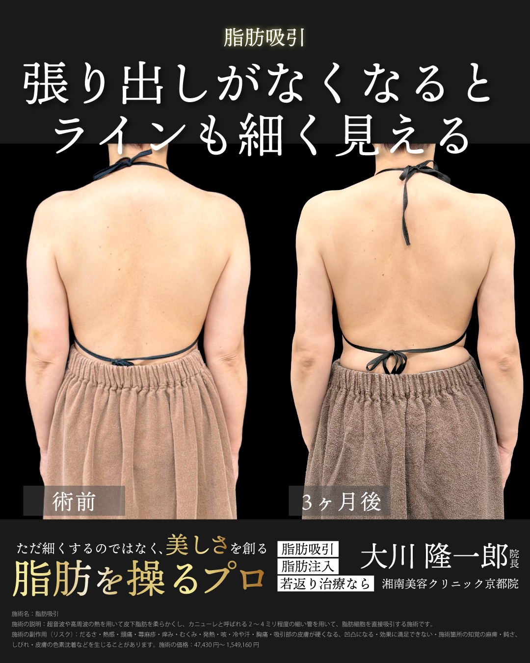 アキーセル脂肪吸引(二の腕全周＋肩＋副乳)＋ベイザー併用の症例